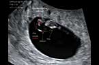 Embryon de 7 SA et 2 jours (LCC = 11.47 mm) - les premiers mouvements embryonnaires - Vidéo