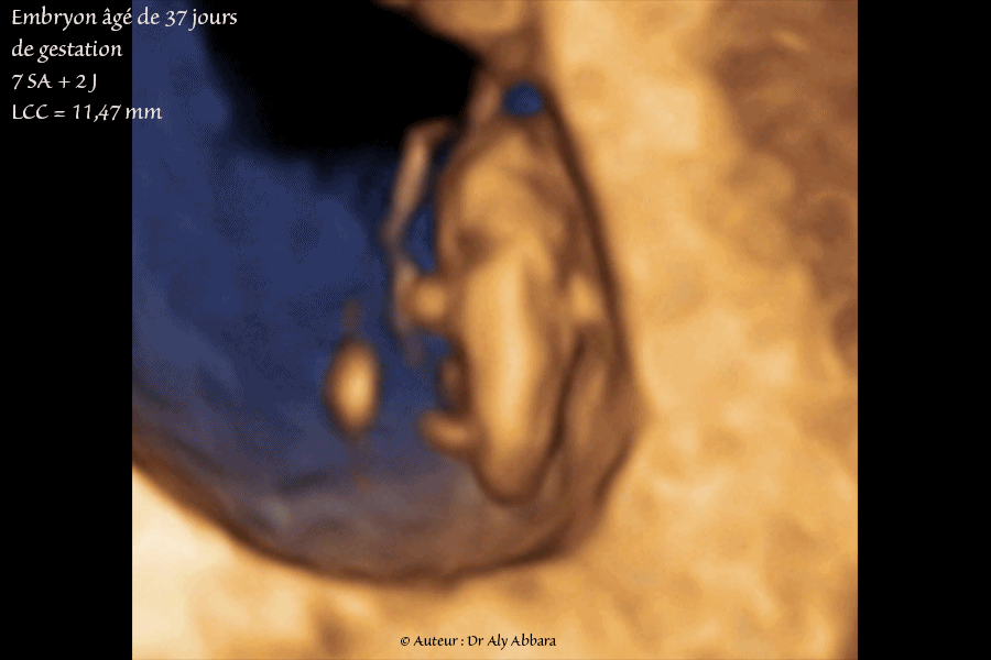Embryon âgé de 37 jours de gestation (7 SA + 2 jours) - Plan dorsal - Images en mode 3D - مضغة بعمر 37 يوماً أو 7 أسابيع 2 و  أيام من اِنقطاع الطمث
