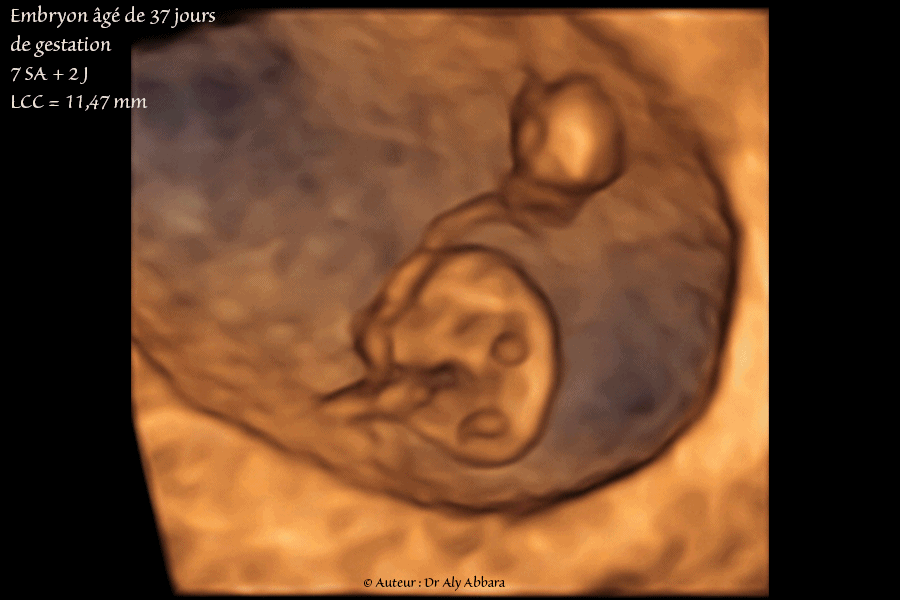 Embryon âgé de 37 jours de gestation (7 SA + 2 jours) - Images en mode 3D - مضغة بعمر 37 يوماً أو 7 أسابيع 2 و  أيام من اِنقطاع الطمث