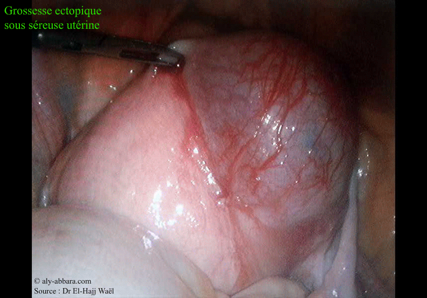 Grossesse extra-utérine sous-séreuse utérine - Images cliniques avant resection