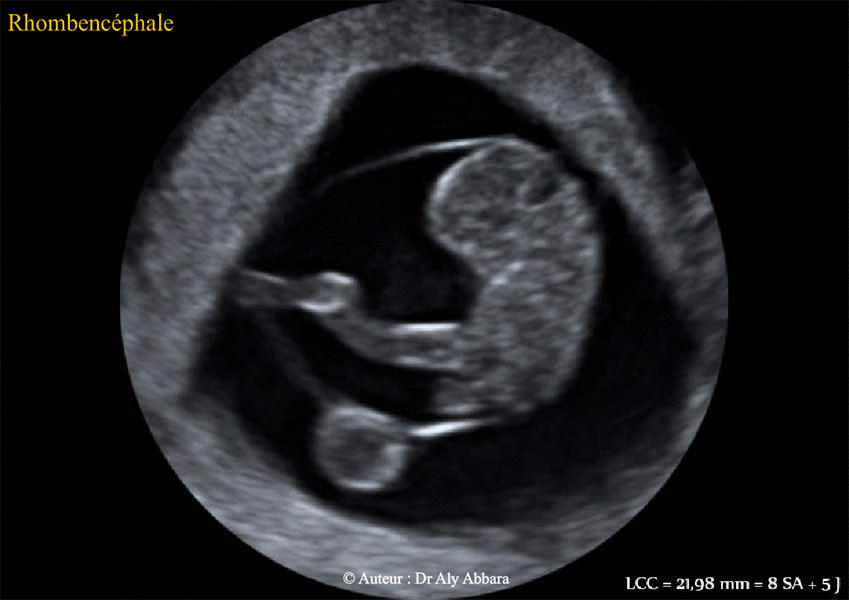 Embryon de 8SA5J - Fosse rhombencéphalique éléments anatomique - échographie