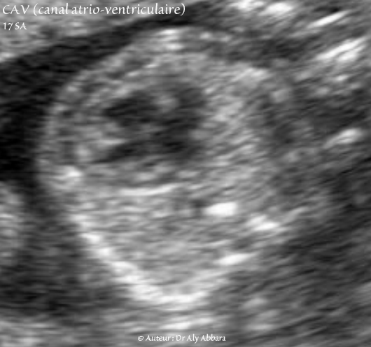 Canal atrio-ventriculaire complet - CAV - Vidéo et image animée échocardiographiques - 17 SA - القناة الأذينية البطينية