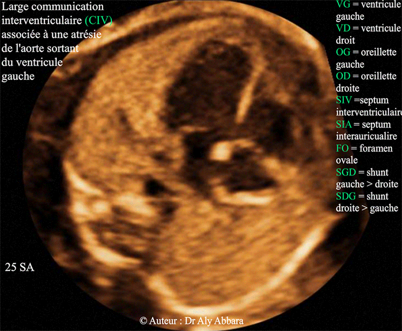 Communication interventriculaire associée à une atrésie de l'aorte ascendante - 25 SA - Echographie
