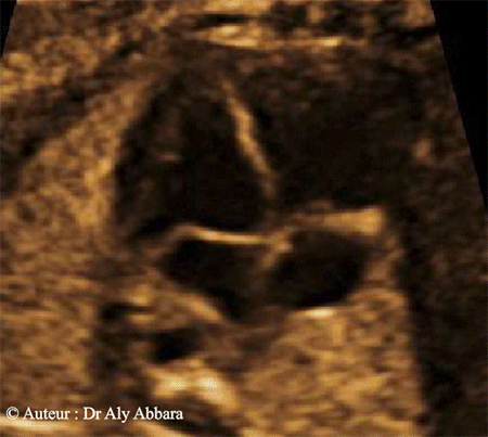 Coeur foetal - Les trois coupes échographiques