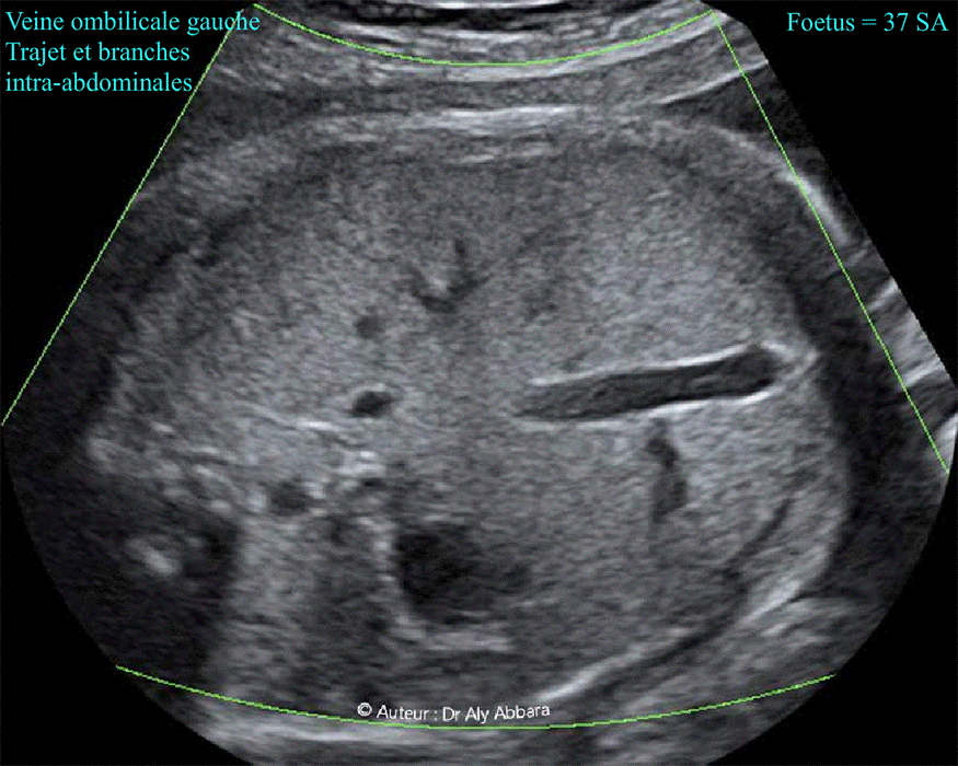 Veine ombilicale gauche normale - Son trajet intra-abdominal et ses branches