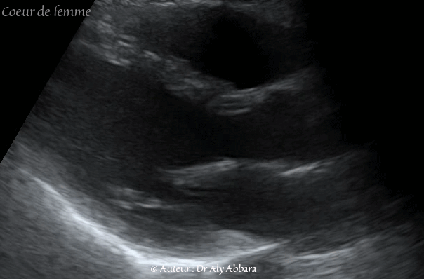 Premiers battements cardiaques chez l'embryon, à 22 jours de gestation - أول دقات القلب عند مضغة بعمر 22 يوماً