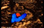 La communication normale et observable entre l'artère pulmonaire et l'aorte par l'intermédiaire du canal artériel - échocardiographie