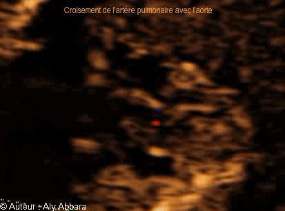 Images échographiques cardiaques montrant le croisement normal et observable entre l'artère pulmonaire et l'aorte.