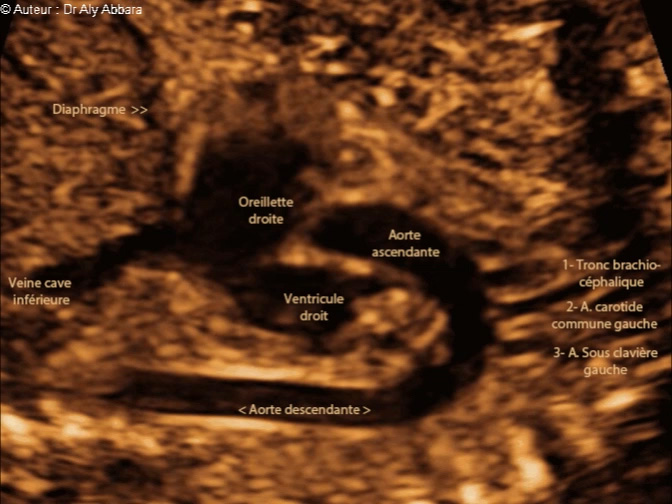 L'aorte de sa naissance du ventricule gauche jusqu'à sa portion descendante : foetus de 22 SA