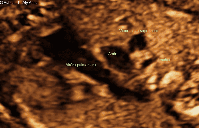 Coeur foetal - la coupe standardisée des trois vaissseaux et la trachée : foetus de 22 SA
