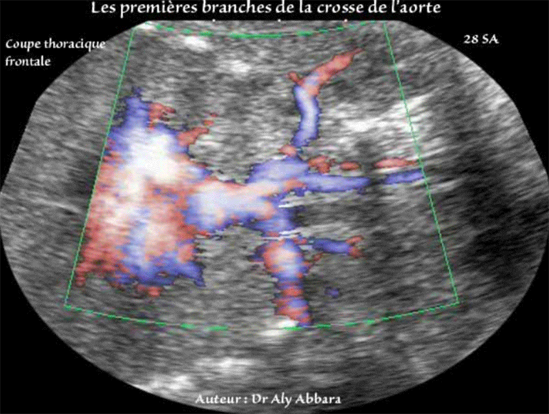 Crosse de l'aorte (foetus) - Ses branches céphalo-brachiales
