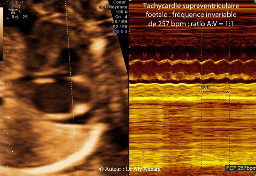 Tachycardie supra ventriculaire avec normalisation du rythme cardiaque foetal spontanément au bout de 20 minutes