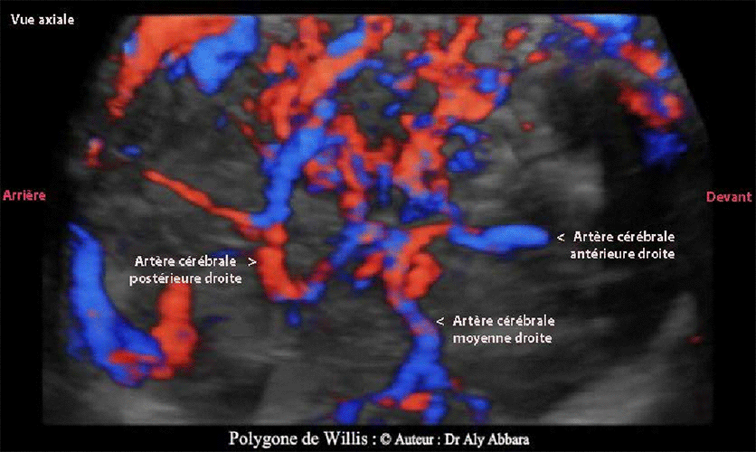 Polygone de Willis -  les trois principales artères cérébrales - Foetus de 29 SA