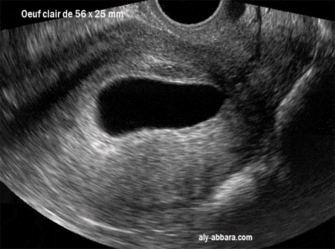 Oeuf clair - sac gestationnel de 56 mm de grand axe sans contenu embryonnaire