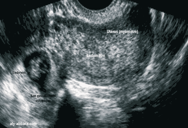 Grossesse ectopique tubaire droite avec un embryon de 12 mm de LCC, avec activité cardiaque présente