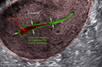 Utérus - l'aspect de l'endomètre et la cavité utérine au cours des premiers jours des règles (de la menstruation)