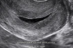 Glaire endocervicale en période pré-ovulatoire - Aspect échographique