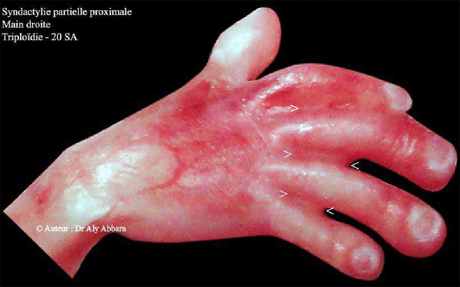 Syndactylie partielle proximale de la main - Triploïdie (caryotype (69, XXX)