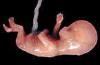 Grossesse de 12 SA - foetus et annexes foetales - images cliniques