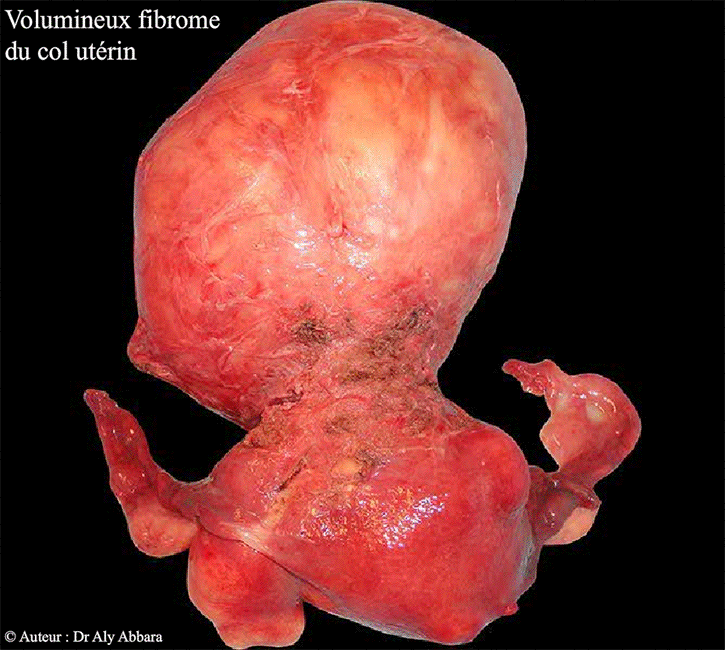Utérus polymyomateux avec un volumineux myome cervical - Image clinique de la face antérieure de l'utérus