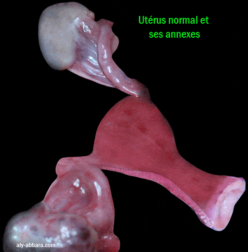 Les anomalies des organes génitaux internes dans le syndrome de Rokitanski-Kuster-Hauser