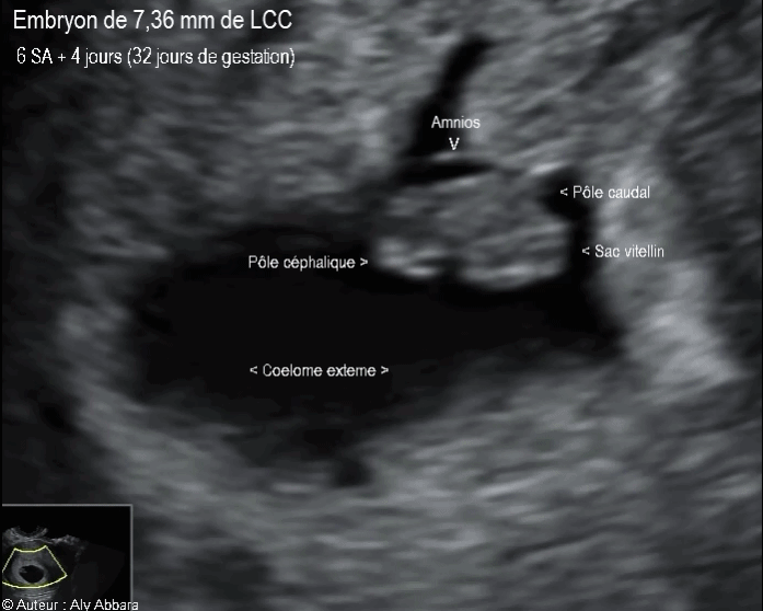 Embryon âgé de 32 jours de gestation (6 SA + 4 jours) - مضغة بعمر 32 يوماً أو 6 أسابيع وأربعة أيام من اِنقطاع الطمث