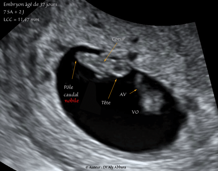 Embryon âgé de 37 jours de gestation (7 SA + 2 jours) - مضغة بعمر 37 يوماً أو 7 أسابيع 2 و  أيام من اِنقطاع الطمث