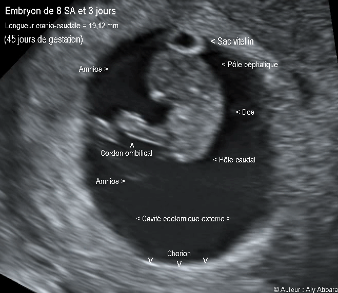 Embryon âgé de 45 jours de gestation (8 SA + 3 jours) - مضغة بعمر 45 يوماً أو 8 أسابيع 3 و  أيام من اِنقطاع الطمث