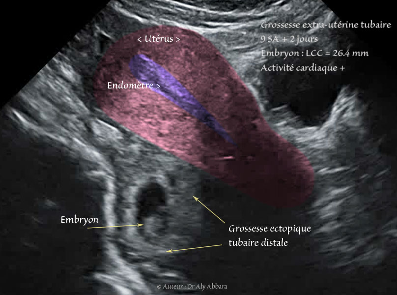 Grossesse extra-utérine tubaire distale évolutive âgée de 9 SA et 2 jours : activité cardiaque positive ; mouvements actifs positifs ; longueur craniocaudale égale à 26,4 mm - -  coupe sagittale médiane de l'utérus
