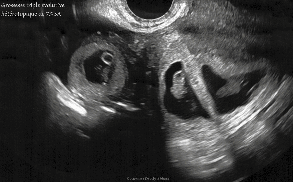 Grossesse triple évolutive hétérotopique composée d'une grossesse gémellaire intra-utérine et une grossesse mono-embryonnaire extra-utérine tubaire droite