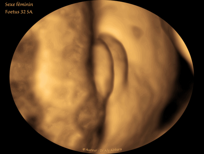Vulve et périnée foetal à 3D ; foetus du sexe féminin de 32 SA
