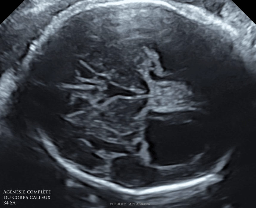 Agénésie complète du corps calleux - Dilatation du 3ème ventricule et absence du cavum du septum pellucidum