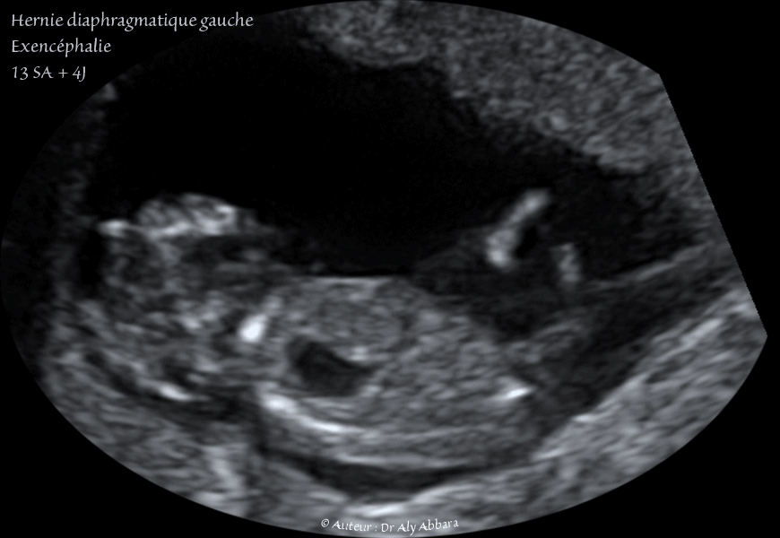 Hernie diaphragmatique et exencéphalie - foetus de 13 SA et 4 jours