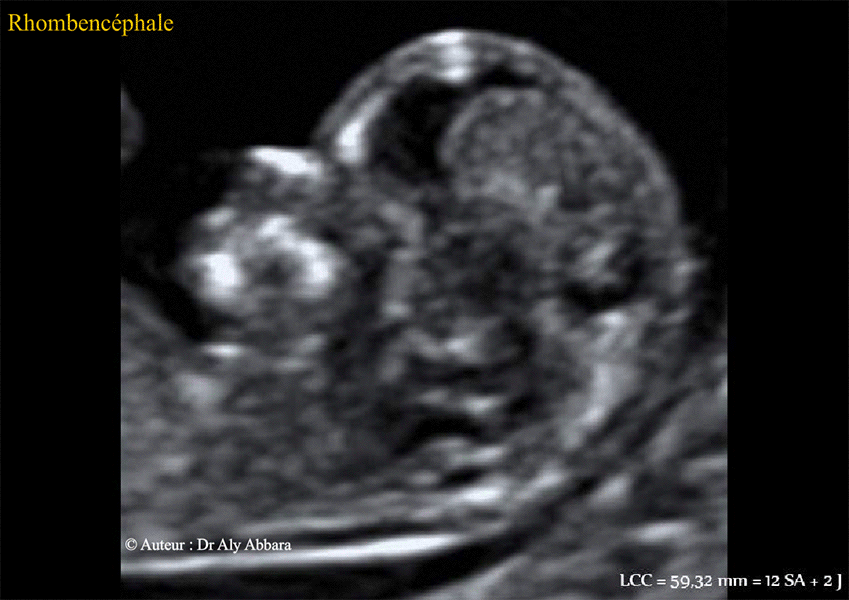 Foetus de 12 SA et 2 jours - Anatomie échographique de la fossesse postérieure
