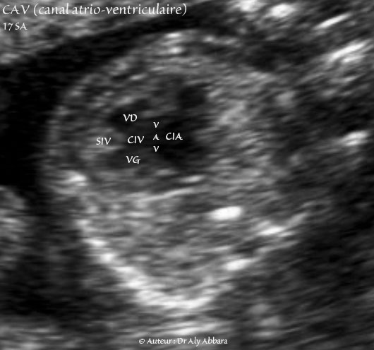 Canal atrio-ventriculaire complet  CAV - 17 SA - Vidéo et image animée échocardiographiques - القناة الأذينية البطينية