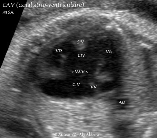 Canal atrio-ventriculaire complet - CAV - 33 SA - Vidéo et image animée échocardiographiques - القناة الأذينية البطينية