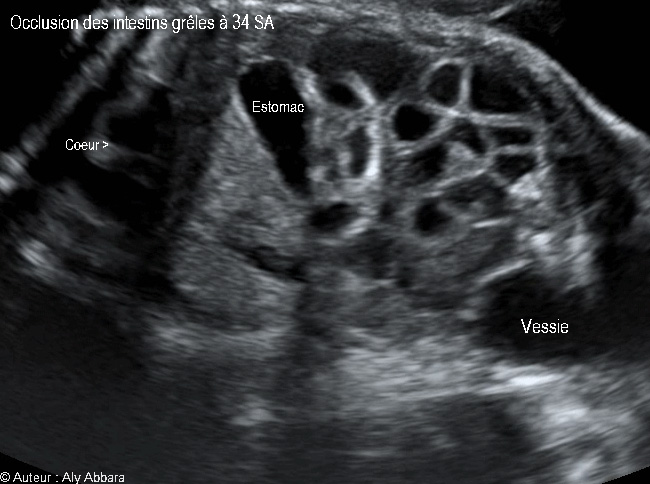 Occlusion intestinale caractérisée par la dilatation des anses grêles et une hyperpéristaltisme : foetus de 34 SA