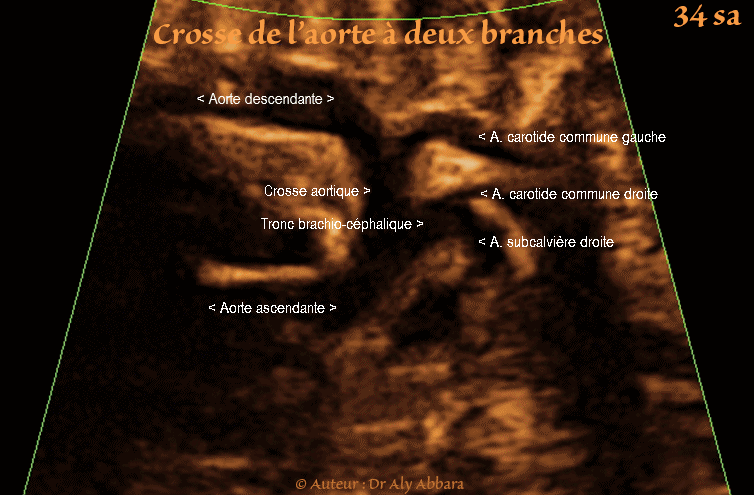 Crosse de l'aorte caractérisée par l'absence de l'artère subclavière gauche : foetus de 34 SA - قوس ابهرية متميزة بغياب فرعها الرئيسي الثالث أي الشريان ماتحت الترقوي الأيسر