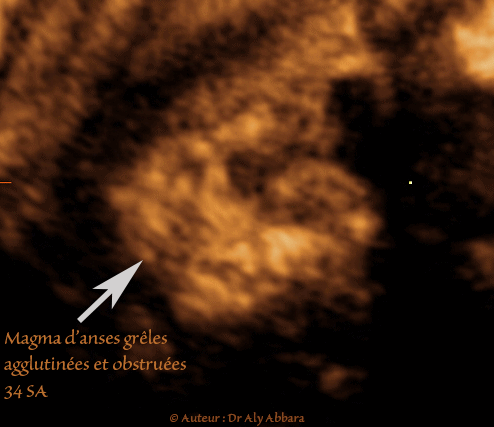 Magma d'anses grêles hyperdenses, agglutinées et obstructives : foetus de 34 SA