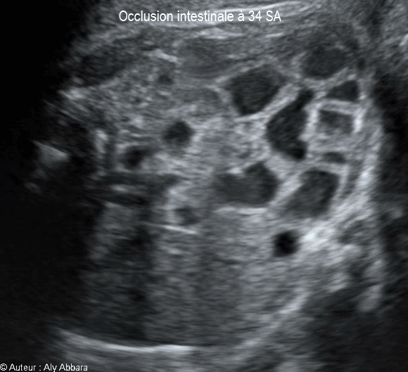 Occlusion intestinale caractérisée par la dilatation des anses grêles et une hyperpéristaltisme : foetus de 34 SA
