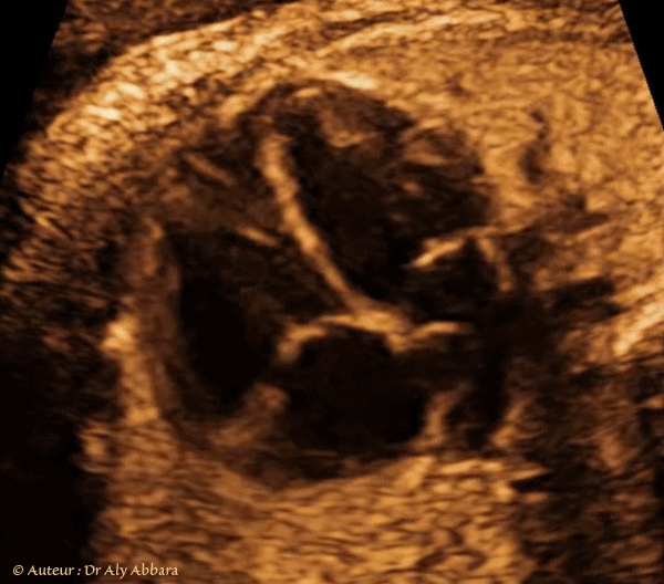 Cœur foetal - coupe classique des quatre cavités - foetus de 36 SA