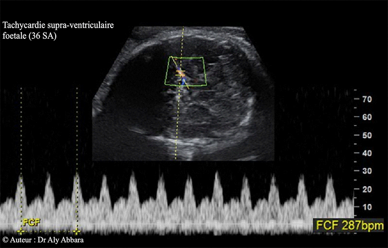 Tachycardie supra ventriculaire - 36 SA - Doppler de l'ACM - Echographie