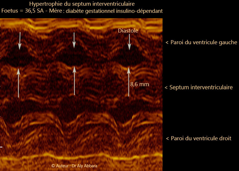 Hypertrophie du septum interventriculaire chez un foetus de 36,5  SA  et mère diabétique insulinodépendante