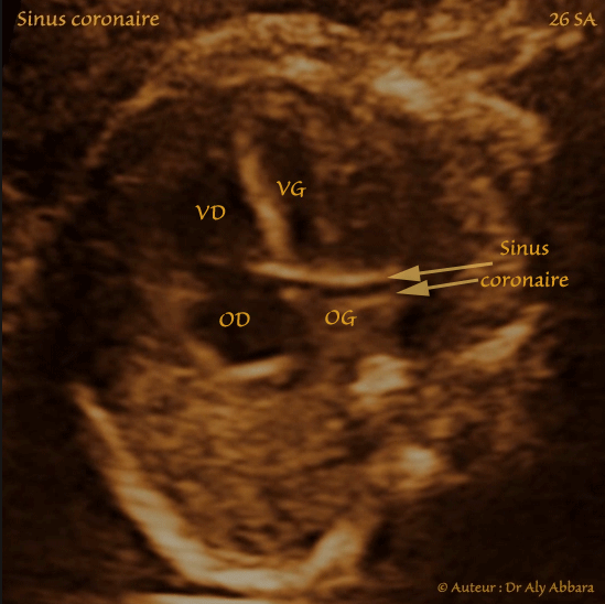 Artère ombilicale unique - grossesse de 33 SA - Absence de d'anomalie associée