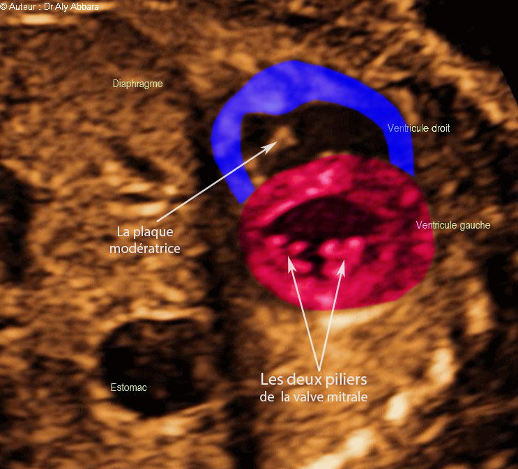 Cœur foetal - la coupe standardisée passant dans la pointe cardiaque : foetus de 22 SA