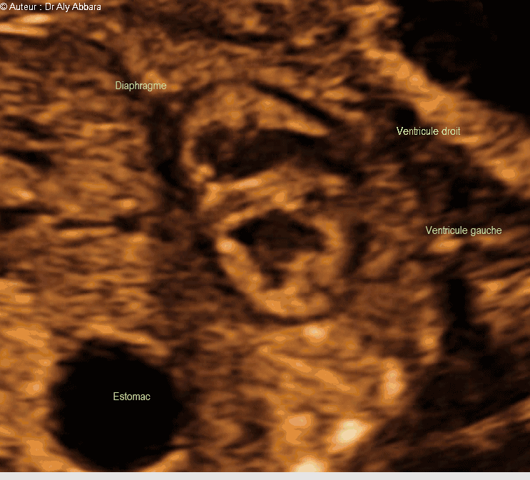 Cœur foetal - la coupe standardisée des trois passant dans la pointe cardiaque : foetus de 22 SA