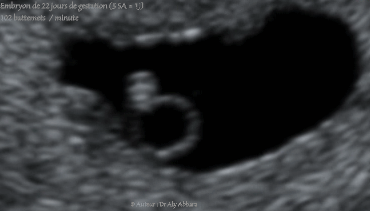 Premiers battements cardiaques chez l'embryon, à 22 jours de gestation - أول دقات القلب عند مضغة بعمر 22 يوماً