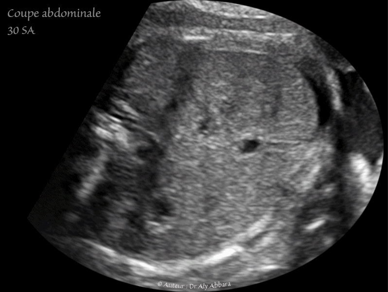 Hernie diaphragmatique et exencéphalie - foetus de 13 SA et 4 jours