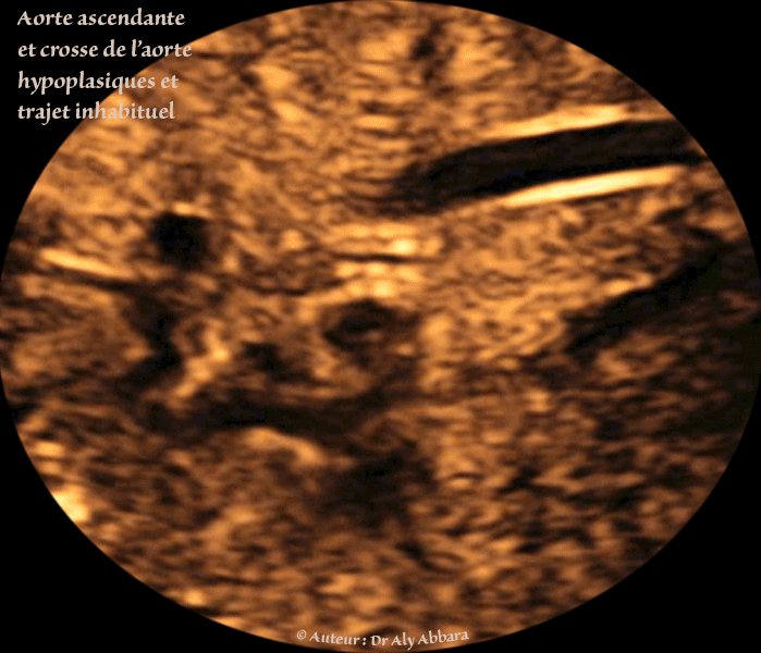 Coupe sagittale sur la crosse de l'aorte : aorte hypoplasique et filiforme avec un trajet irrégulier, tortueux