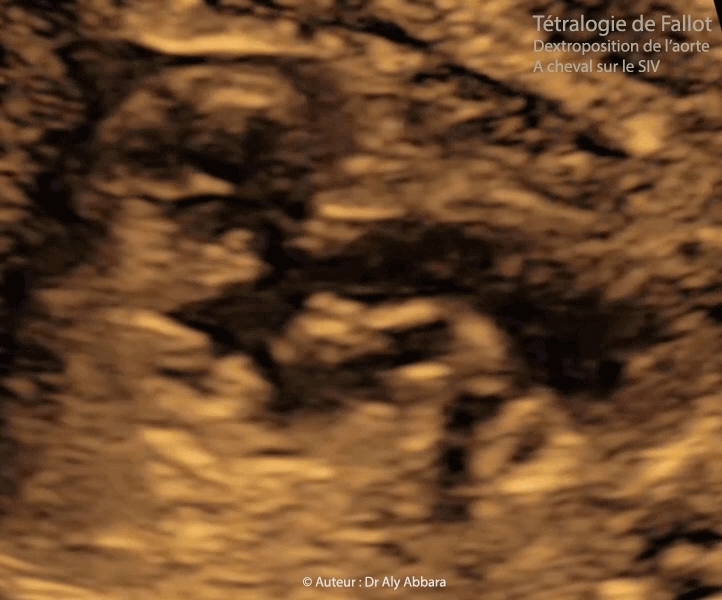 Aorte dilatée et à cheval sur le septum interventriculaire - Large communication interventriculaire périmembraneuse